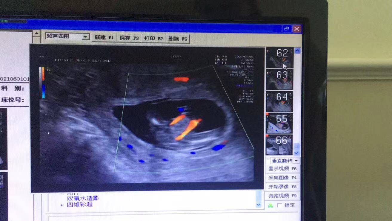 NT篩查出胎兒多發(fā)畸形，準(zhǔn)媽媽無奈終止妊娠